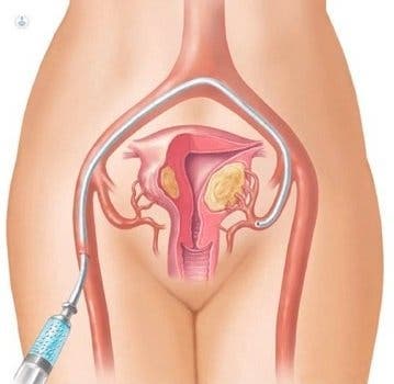 Embolización de fibromas, un procedimiento mínimamente invasivo