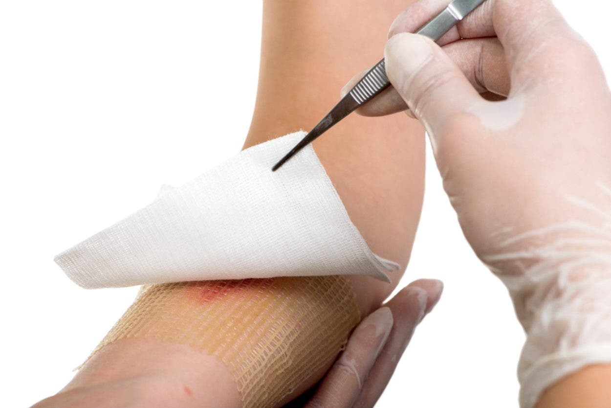 Terapia presión negativa, novedad para tratar heridas en casa
