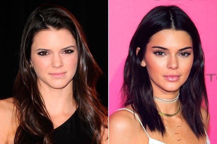 Mila Kunis y Kendall Jenner son dos de una larga lista de famosas que se han sometido al popular procedimiento para perfilar el rostro.