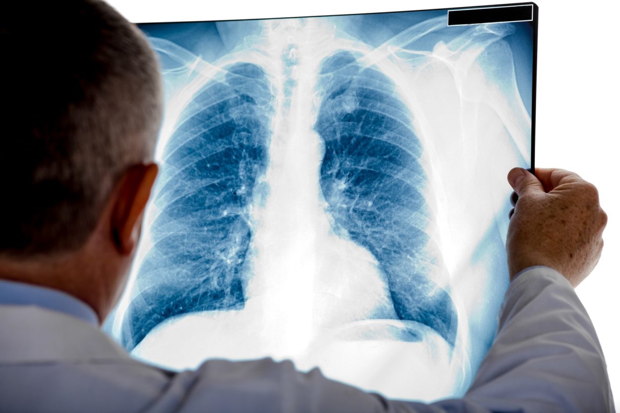 Prueba acelerará diagnóstico pacientes cáncer pulmón