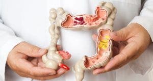 Biomarcadores que predicen respuesta al tratamiento cáncer de recto