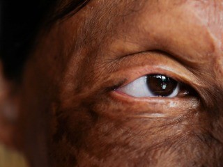 Cambio de piel- la transformación de las sobrevivientes ataques con ácido