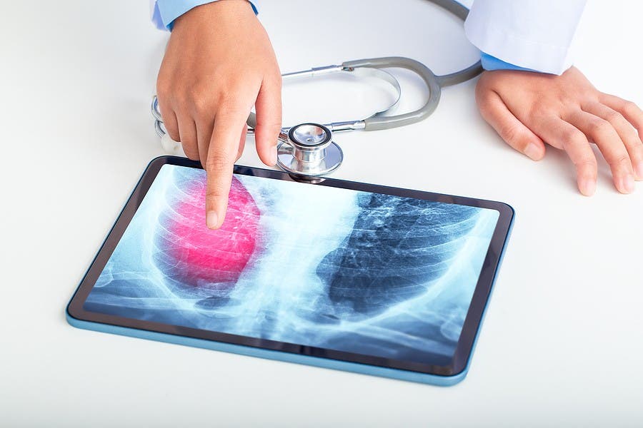 Atención tardía de cáncer de pulmón eleva muertes y costos en Latinoamérica