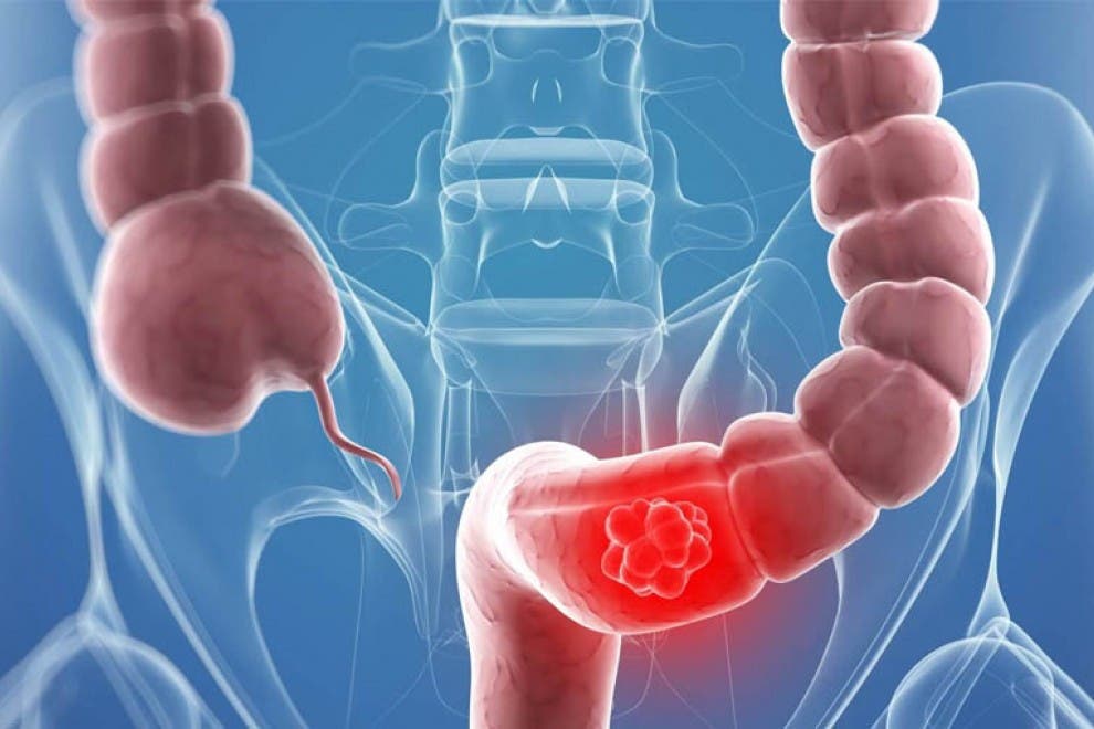 Estudios revelan cifras de cáncer de colon son “muy elevadas” en el país