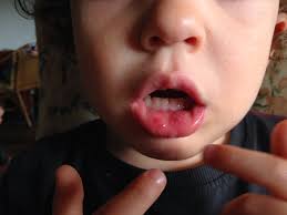Enfermedad boca, mano, pie: Un infección vírica frecuente que afecta a los más pequeños