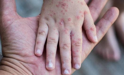Salud Pública emite alerta epidemiológica por sarampión