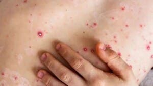 Alertan a neoyorquinos ante brote viruela del mono