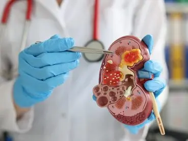 Las alteraciones genéticas del cáncer renal infantil abren la puerta a nuevos tratamientos