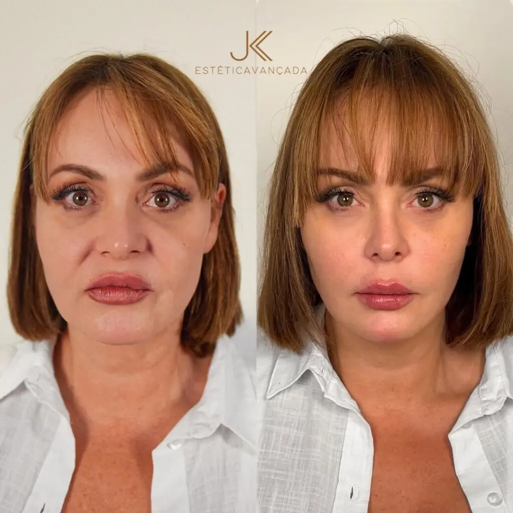 La transformación de Gaby Spanic: Rejuvenecimiento facial a casi 52 años