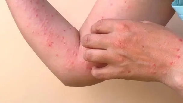 Tres viajeros desde Cuba dan positivo a chikungunya; Salud Pública refuerza vigilancia