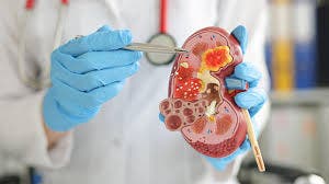 Impactante: cerca de 800 millones padecen enfermedad renal crónica en el mundo