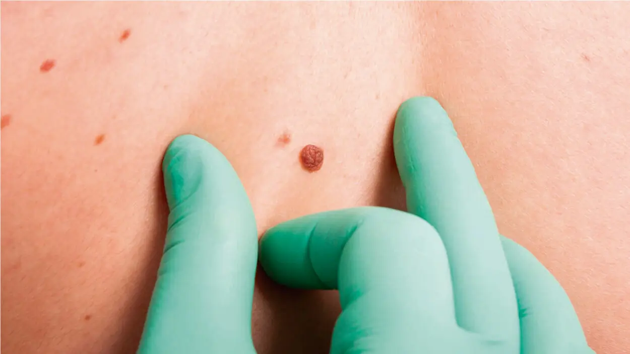 Dermatóloga alerta aumento silencioso del cáncer de piel en República Dominicana