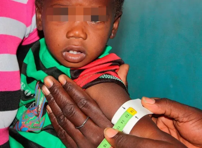 Advierten que la desnutrición complica la recuperación de pacientes ingresados