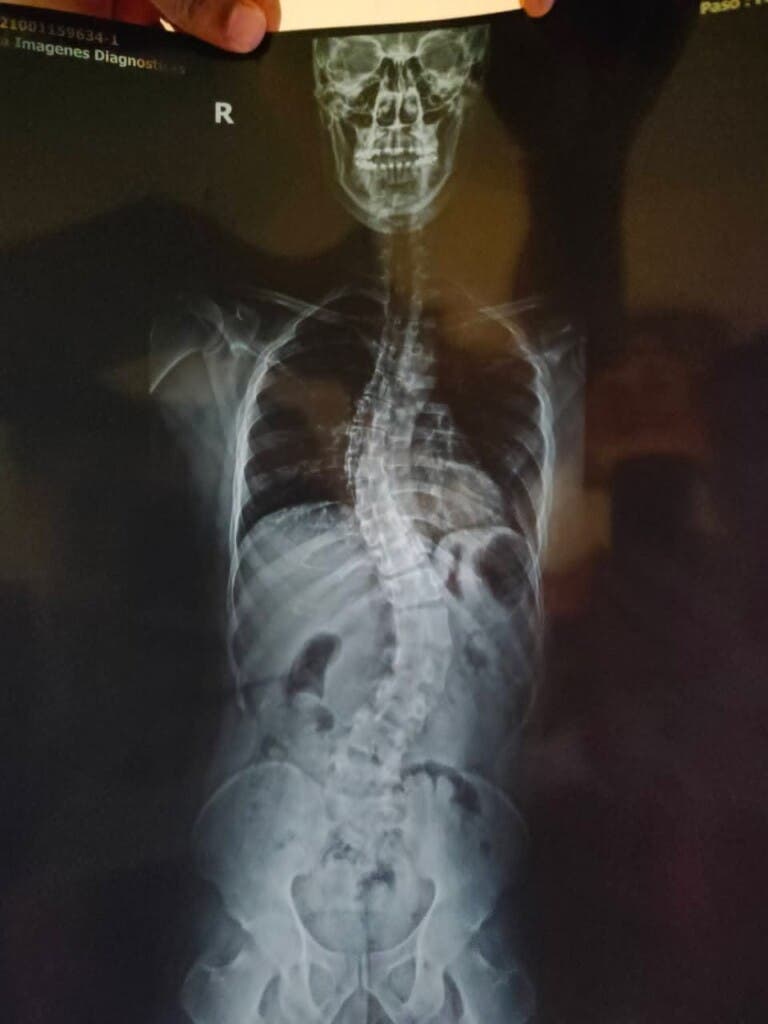 Tras 13 cirugías, joven lucha por su salud y pide apoyo