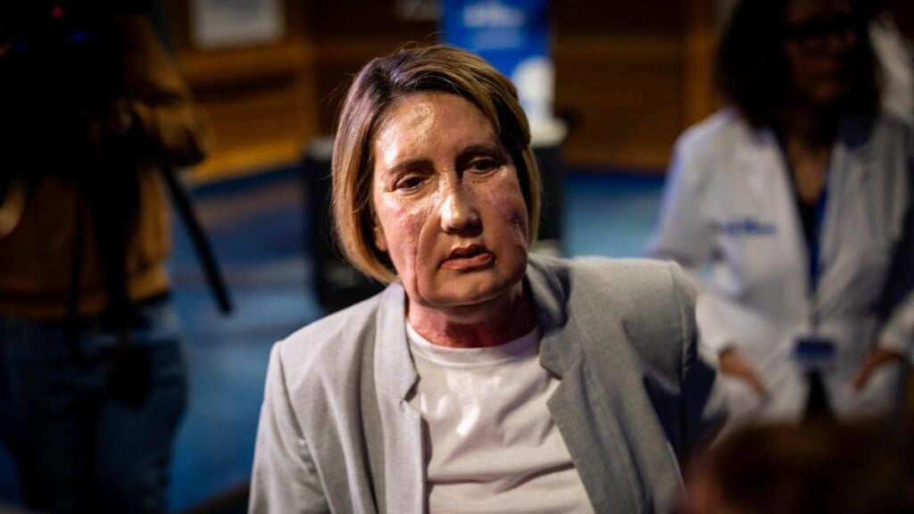 Realizan en España primer trasplante de cara con donante de eutanasia