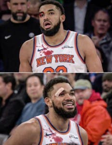 Corte en ojo derecho no detuvo a Anthony Towns  en victoria Knicks
