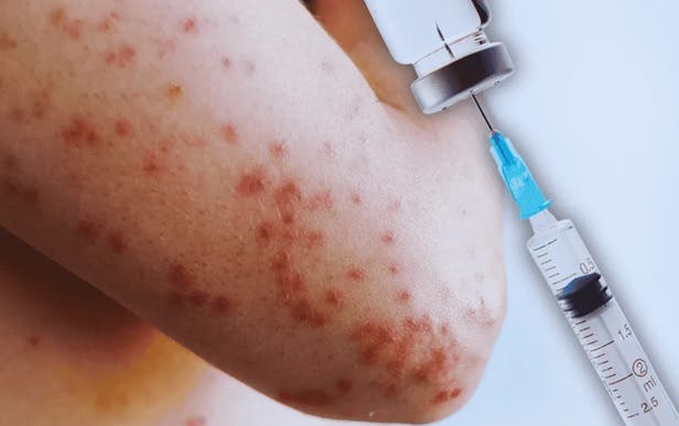 Alerta en Nueva York: Por brote de sarampión