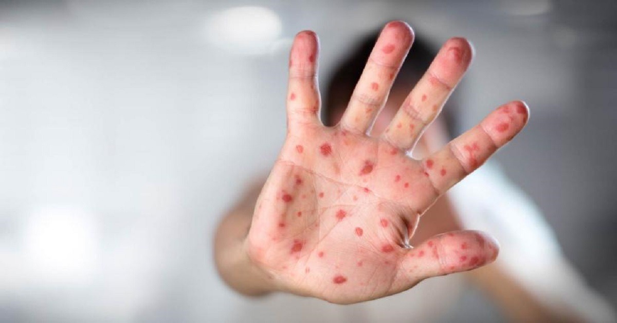 México supera los 10.000 casos de sarampión en un brote que ha provocado 31 fallecidos