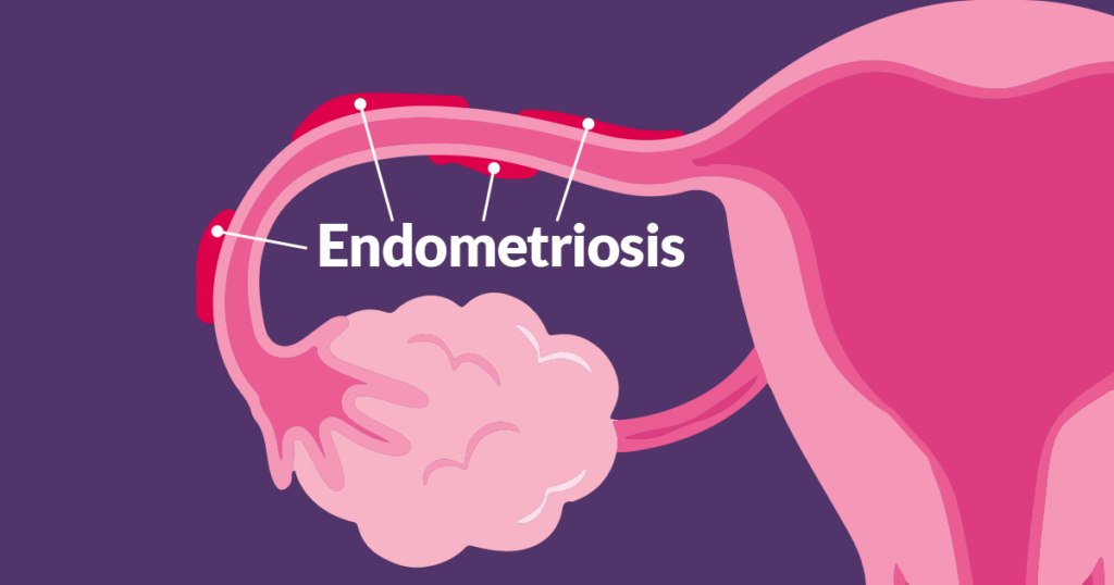 Endometriosis: cuando el dolor menstrual es una señal de alerta