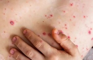 Mpox llega a Nueva York: conoce los síntomas y cómo se transmite