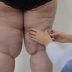 Si haces dieta y ejercicio y no ves resultados, podría ser lipedema
