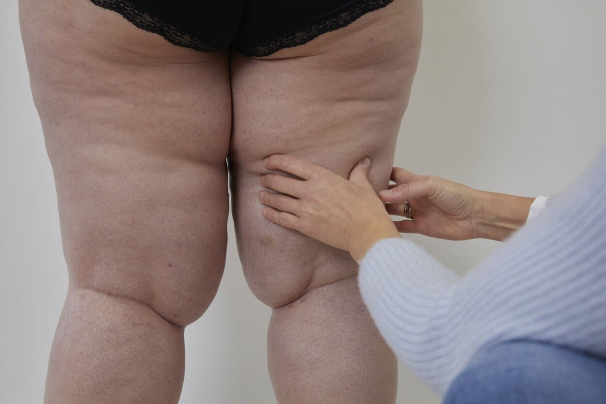Si haces dieta y ejercicio y no ves resultados, podría ser lipedema