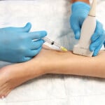 Alertan sobre el avance de las enfermedades venosas en República Dominicana