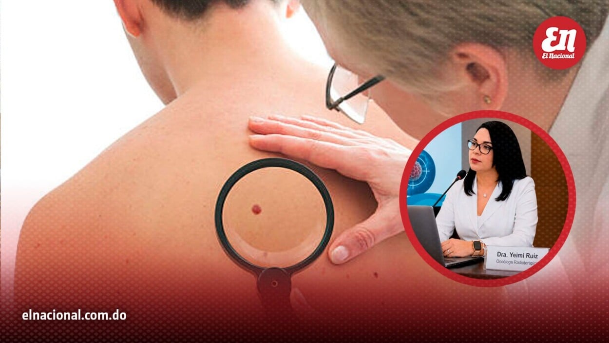 Melanoma maligno: el cáncer de piel más agresivo que puede comenzar con un simple lunar